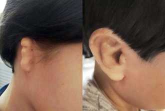 Фото уха после операции медпор у Славы