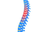 В Израиле разработан новый метод лечения сколиоза