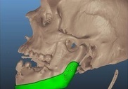 Пациенту установили челюсть, напечатанную на 3-D принтере