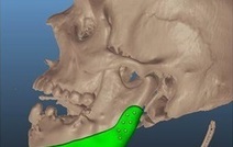 Пациенту установили челюсть, напечатанную на 3-D принтере