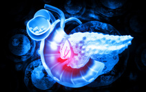 «Линпарза» - прорыв в лечении рака поджелудочной железы