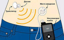 Искусственная поджелудочная железа: новое слово в лечении сахарного диабета