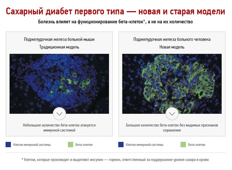 Новая и старая модели развития сахарного диабета первого типа