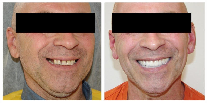фото пациентов после зубного подъёма 