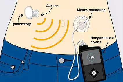 Как работает искусственная поджелудочная железа